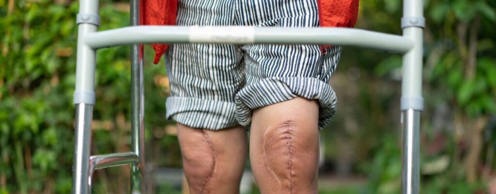 Exercise After Knee Surgery in Taxes